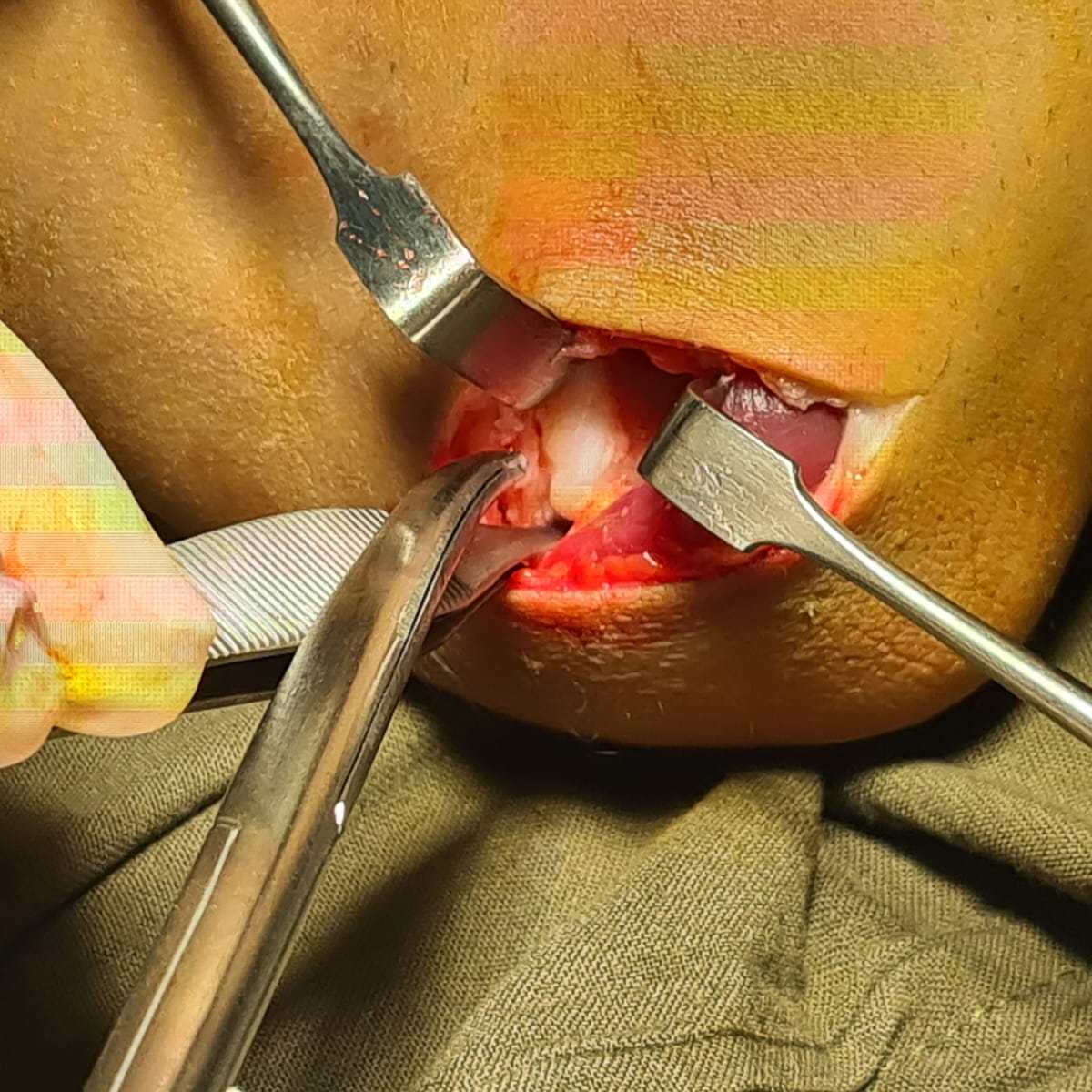 Panner’s Disease and Osteochondrosis of Capitellum of&nbsp;Humerus